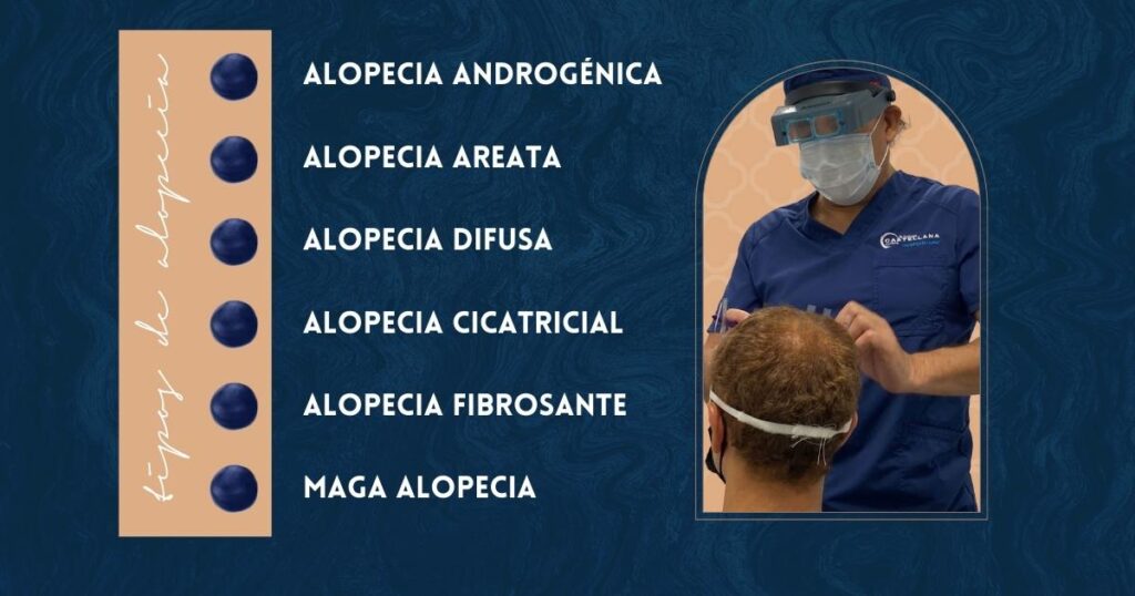 tipos de alopecia masculina