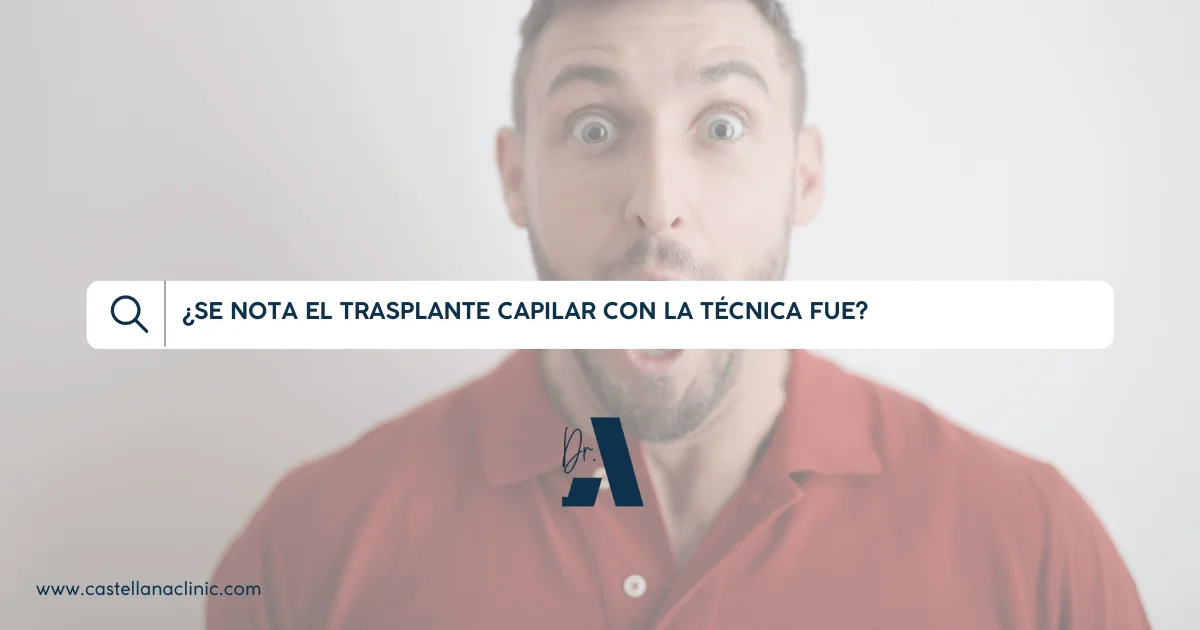 ¿Se nota el trasplante capilar con la técnica FUE?