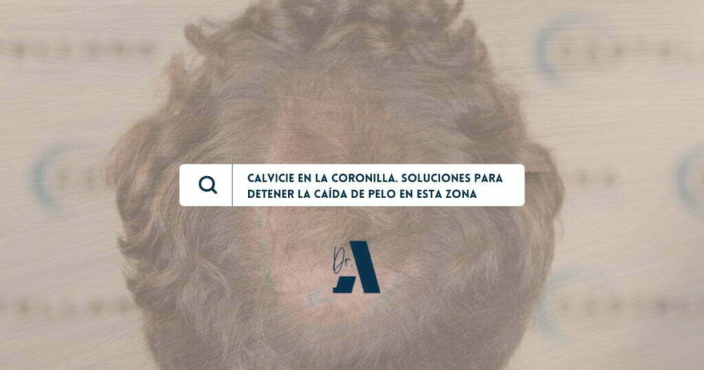 Alopecia en la coronilla