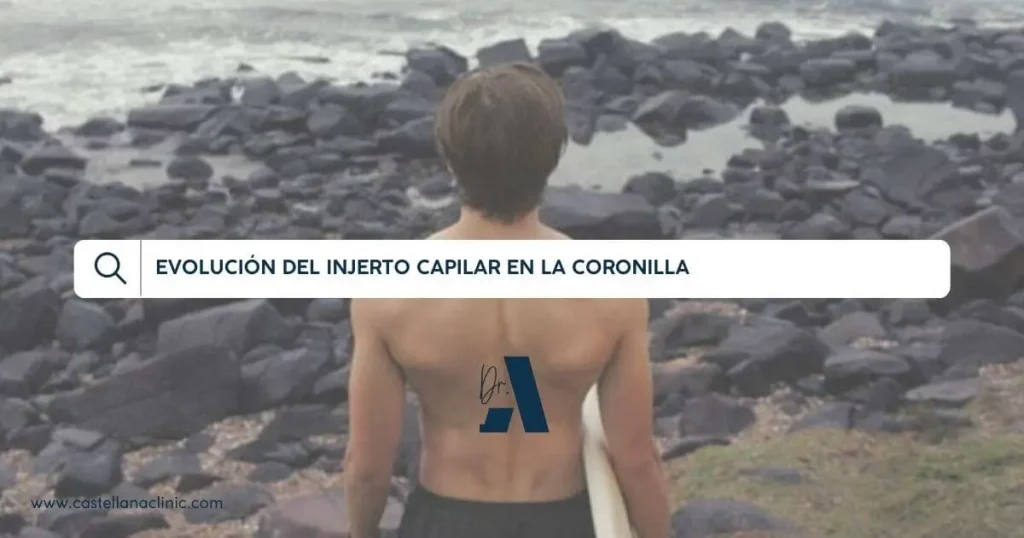 injerto capilar en la coronilla