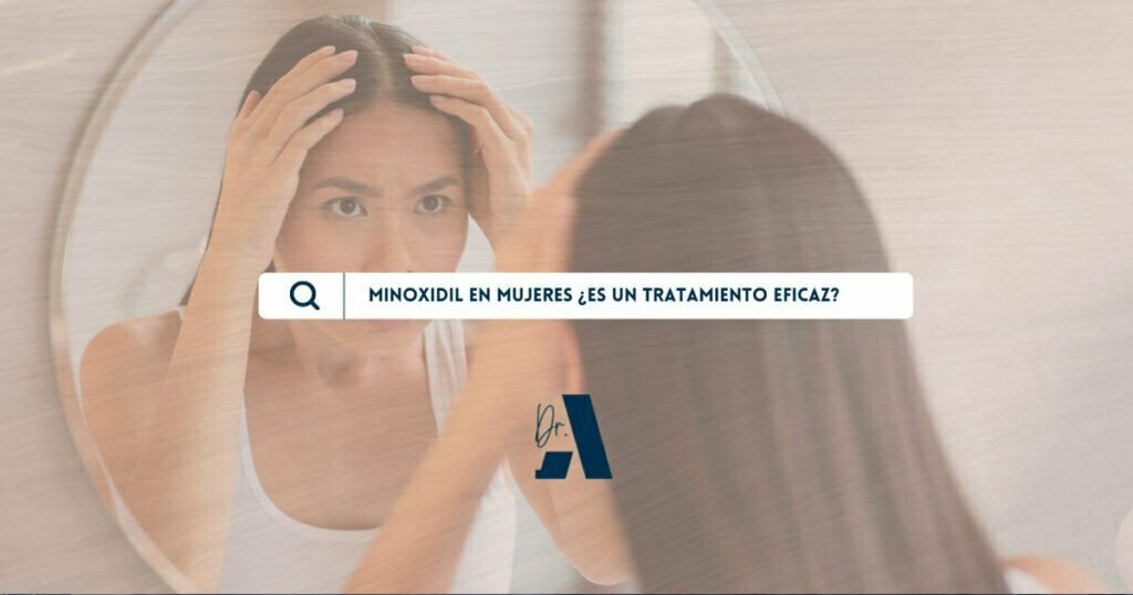 mujer experimentando caída de cabello, tomará minoxidil en mujeres