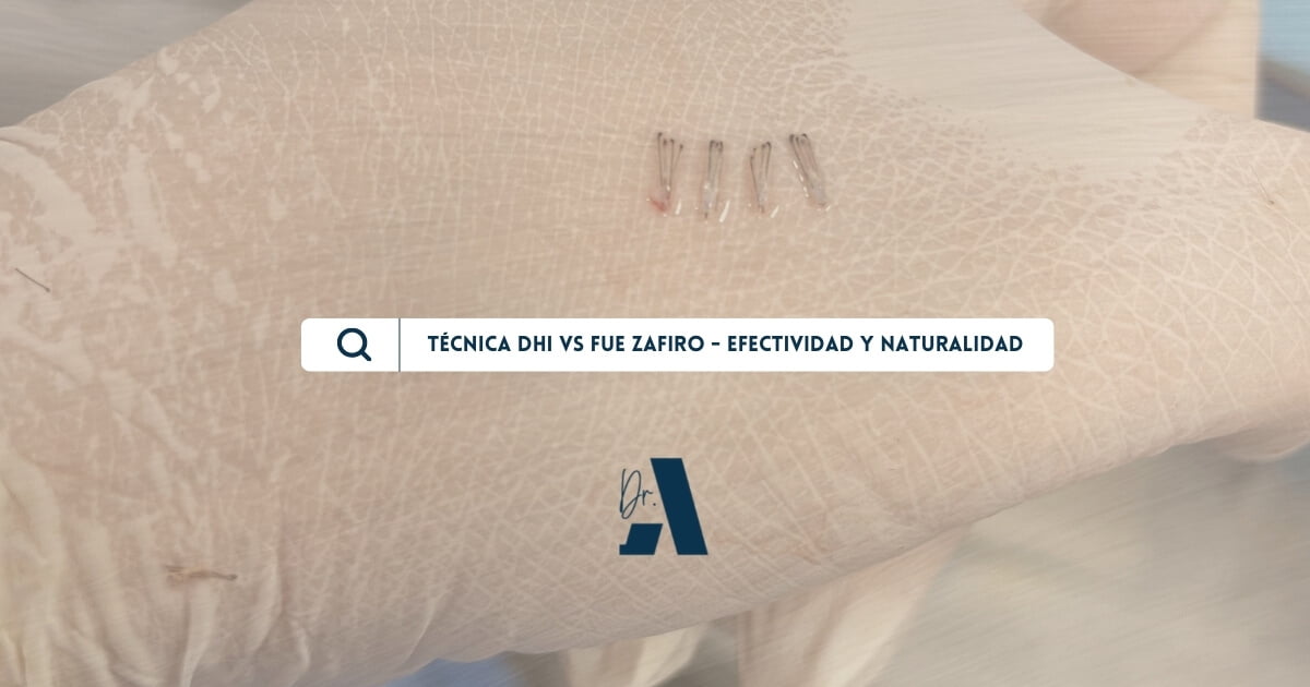 Técnica DHI vs FUE Zafiro ¿Te gustaría saber más sobre ellas?