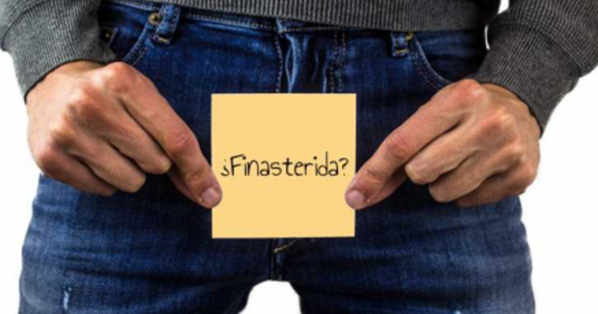 ¿Hay desafíos sexuales en el tratamiento de la alopecia androgenética?