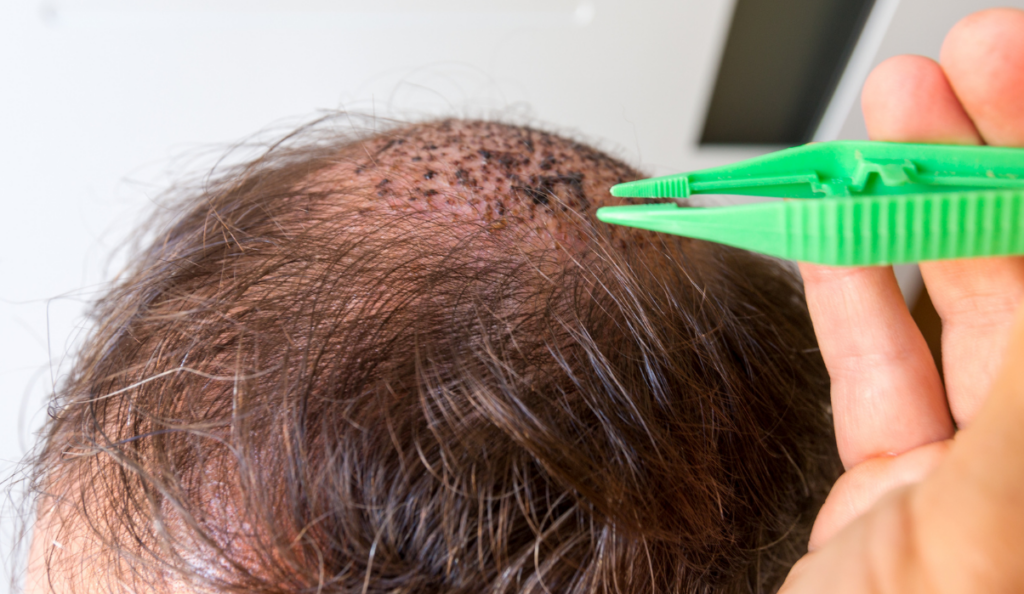 Injerto capilar o tricologia capilar