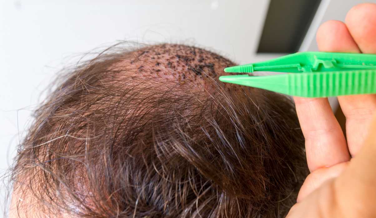 ¿Injerto Capilar o Tricología Capilar? Diferencias claves y cuál Elegir