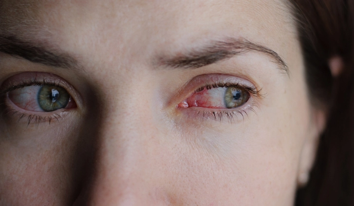 Ojo irritado y enrojecido como consecuencia de una reacción, mostrando extensión de pestañas riesgos y sus posibles efectos secundarios.