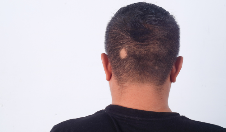 ¿La alopecia areata se cura sola? ¿Cuándo puede ocurrir?