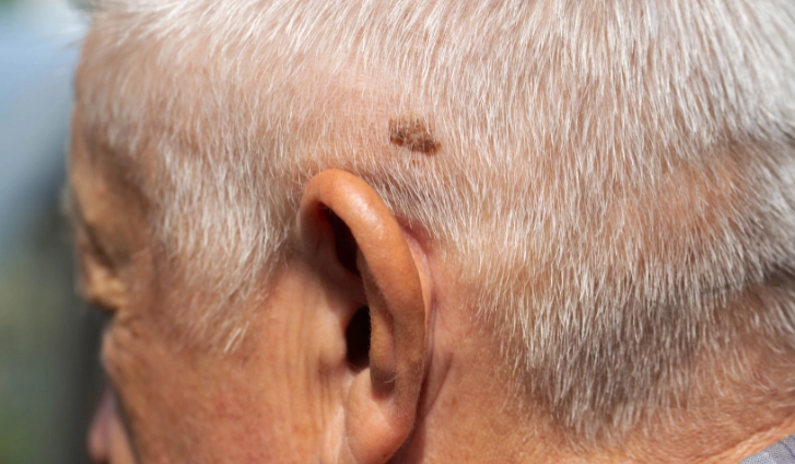 ¿Cómo saber si tengo un melanoma del cuero cabelludo?